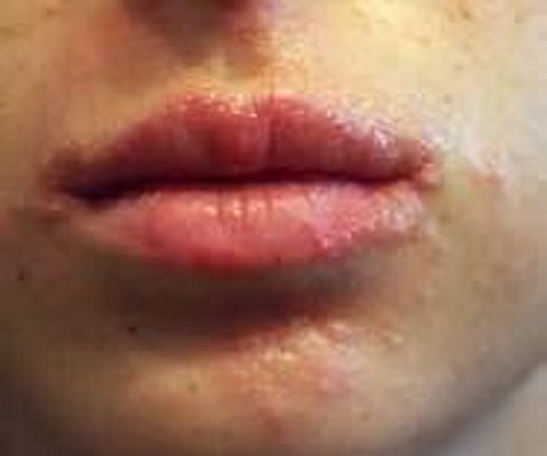 reasons-your-lips-itch-you-and-how-to-treat-it-9jastreet