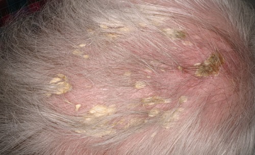 What You Should Know About Seborrheic Dermatitis